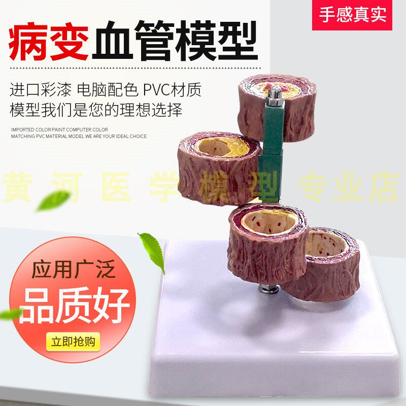 硬化支脉粥样血管模型 心血管动脉解剖模型 人体病态血管模型血栓