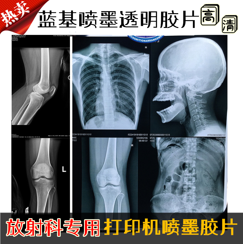 Medical Negatives Inkjet Blue Sheet Blue Based Dry Radiology Printing Negatives Dental Fractures X-ray DR CR CT