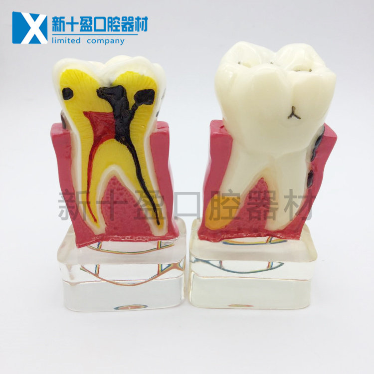 Dental model Crystal Transparent Pathological Model Quadruple Pathologist Communication with Dental Neurosis