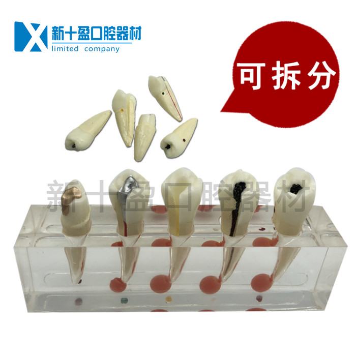 Tooth Root Canal Model Root Canal Repair Tooth Model Dental Pulp Endodontic Tooth Pathological Root Canal Repair Model