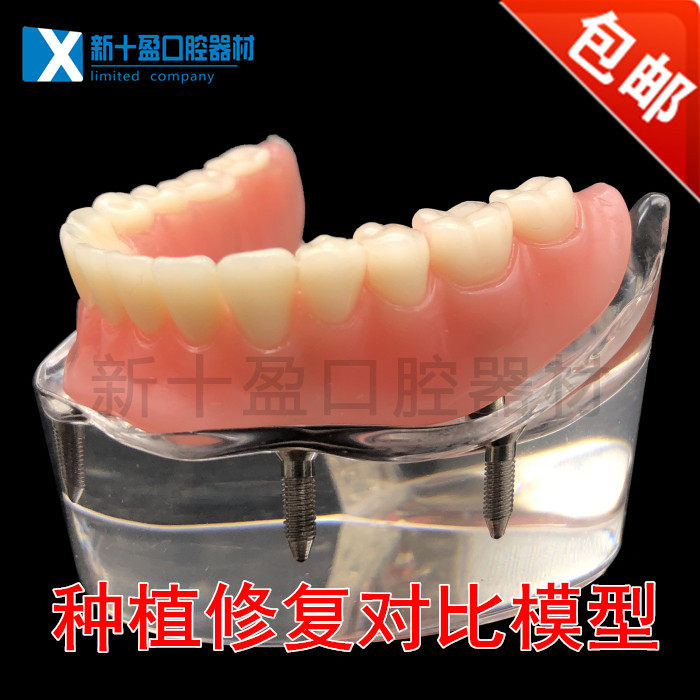 Dental materials New implant and repair model 4 nails 4 nails repair model doctor-patient communication model