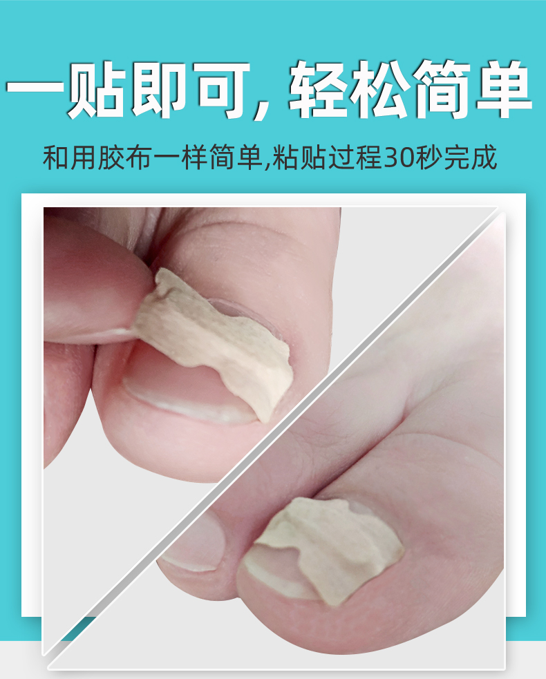 脚医生 甲沟炎甲沟嵌甲矫正贴片 图2