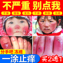Frostbite cream will cure antifreeze and itching. Frostbite cream hand frozen hand antifreeze anti-cracking child adult female hand and foot winter