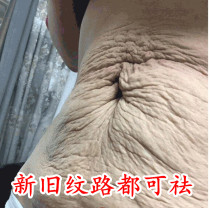 Dispel the pregnancy texture repair cream Oil Obesity Tattoo Orange Peel Tattoo remove compact to prevent postnatal special