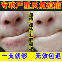 Pimples around the mouth to chin repeatedly long beans closed mouth acne conditioning acne acne red and swelling hard lump artifact