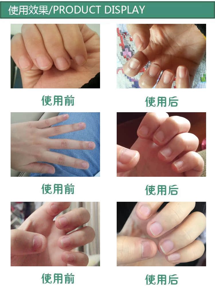 Chất lỏng tăng trưởng móng tay của Nga Người lớn khuyến mãi sửa chữa tay và chân ngón tay chăm sóc móng tay bút dầu dinh dưỡng - Sơn móng tay / Móng tay và móng chân nail cho da ngăm