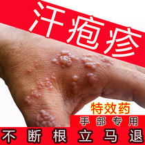 Special ointment for treating small blisters and sweat herpes on the hands