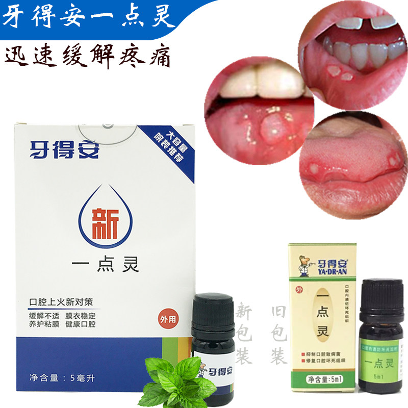 Yidean a little Ling 5ml oral ulcers mouth ulcers recurrent repair tongue blistering mouth ulcers