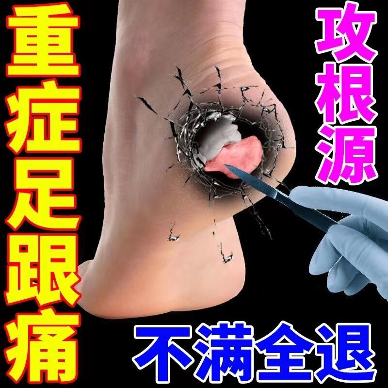 (Can run on the same day) Heel pain paste heel pain plantar fasciitis ointment paste special artifact for bone spur removal