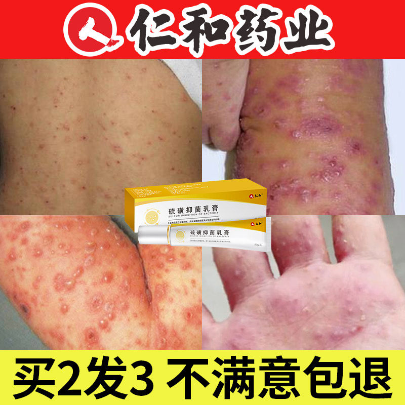 The body of Renmin and Sulfur Sulphur Yellow Cream Body with red bumps in the body Sulphur Cream Mites Mites Scabs Scabs Scabs Scabs With Small Blisters