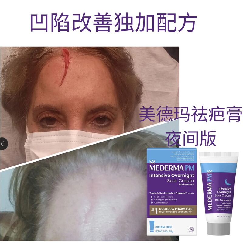 Medema Scar Removal Cream Night Version Is Used at Night to Intensively Fade Acne Marks, Scars, Depressions, Hyperplasia, Bruises, Surgical Scars, and Hyperpigmentation