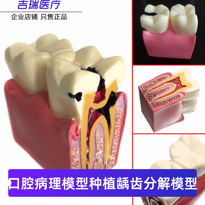 牙科教学模型 6倍龋齿对比模型 口腔护理教学套装