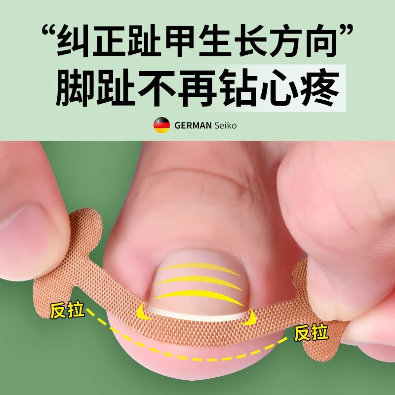 Nail Groove Corrector, Ingrown Toenail Correction Patch, Nail Inflammation Correction Device, Special Patch for Correcting Toenails Embedded in Flesh, Nail Pad