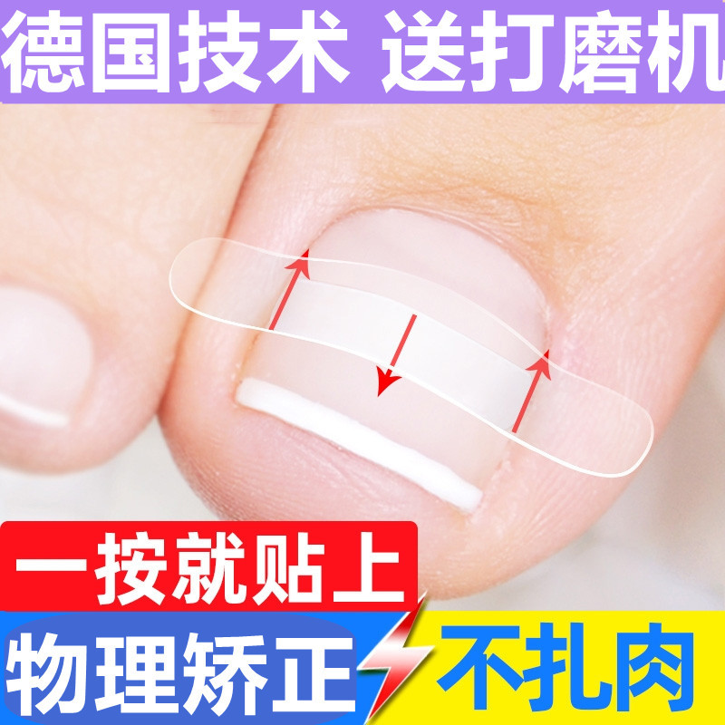 Nail Correction Patch with Embedded Buckle, German Groove Roll Nail Patch, Toe Cover, Glue Remover, Nail Inflammation in the Flesh