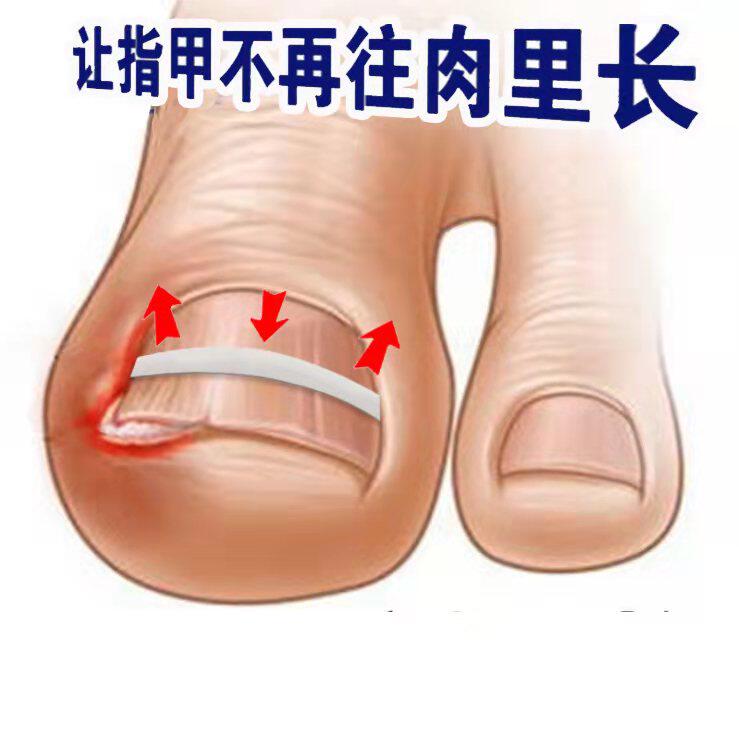 Row Bodyfoot Cora La Pull Pull Patch Positive Toe Nail Trench German Suit of Flesh Embedded Chia Straightener
