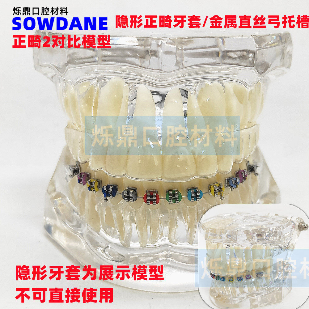 牙科牙模型隐形正畸模型医患沟通讲解教学模型正畸2种对比模型