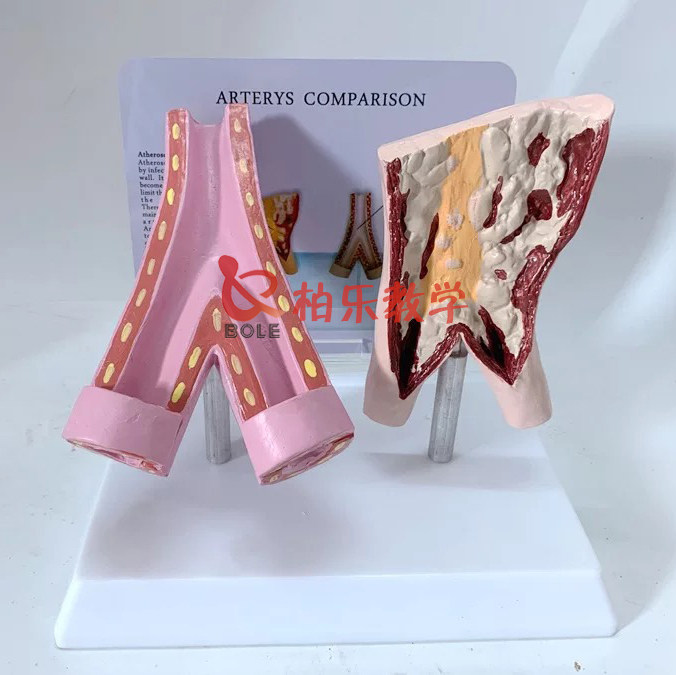 吸烟血管与健康正常血管比较模型病变人体教学科普展示讲解模具