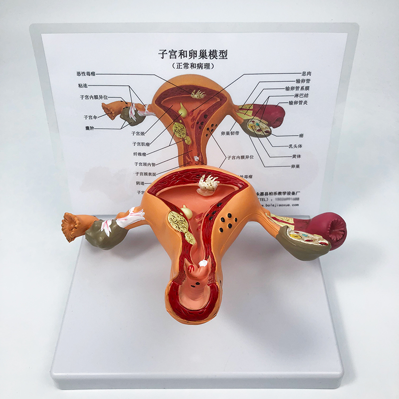 Pathological Uterus Anatomy Model Internal Reproductive Organ Lesions Ovarian Pathology Obstetrics and Gynecology Uterus Mold Teaching