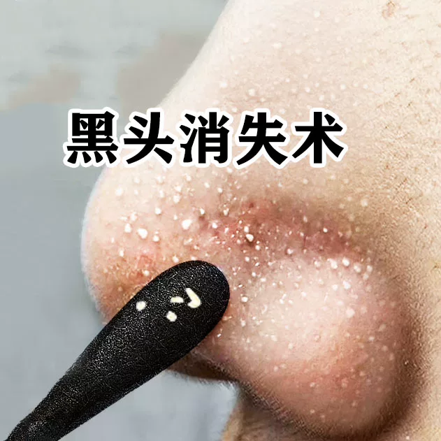 (Bend down with a hot push) Don't squeeze me to suck out the pores dirty to clean the face pores dirt-Taobao