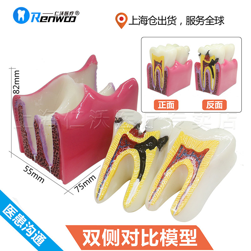 牙齿模型 龋齿分解模型  龋齿对比模型 牙州病变 口腔 牙科模型