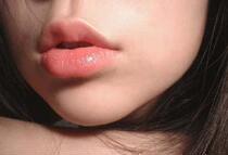 Cheilitis (INTRA)