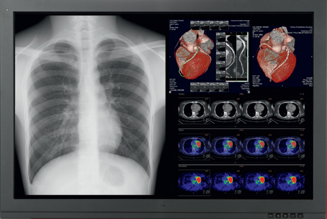 Xianyi 6MP color medical display 30 inch Friends giant shark huge peak Bako Yi Zhuo