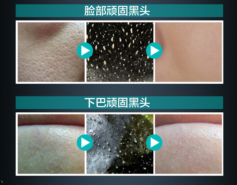 Triều đại thảo dược để đắp mặt nạ đen rách màng mũi thu nhỏ lỗ chân lông nam nữ sạch sâu mụn trứng cá - Mặt nạ viên uống collagen dhc