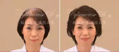 Women's seborrheic alopecia, postpartum hair loss, white hair, cover invisible, non-trace hair, suitable for the top of the head.