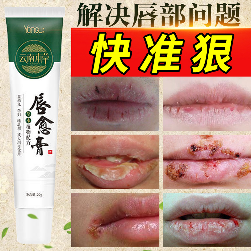 Lip Precious Lip Repair Nourishes Lip Balm Moisturizing Lips Dry Cracked Peeling Skin Pitchy Mouth Corner Cleft Male And Female Child