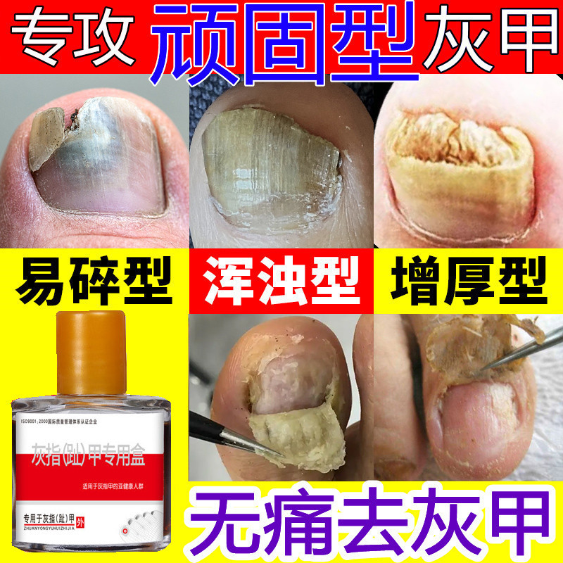 Thickening and Yellowing Toenails, a Magic Solution for Gray Nails, Medicine for Turning Thick, Yellow, and Hard Toenails into Healthy Nails