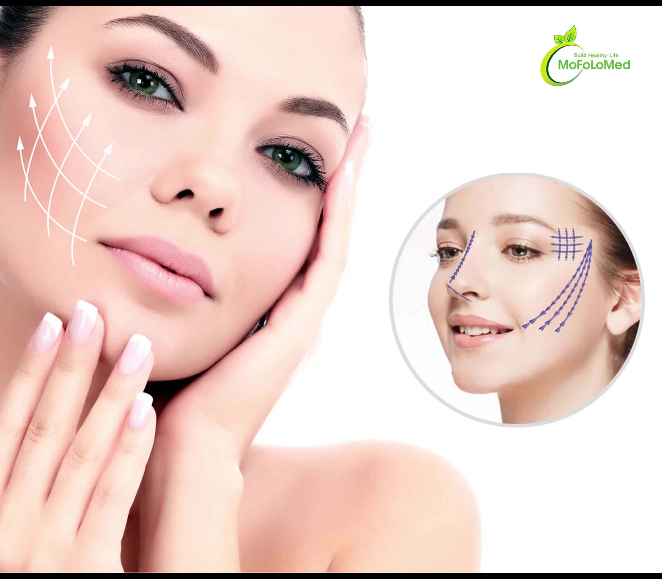 Korea Pdo Nova Face Thread Lift Products Buy Nova Lift Facelift,Pdo