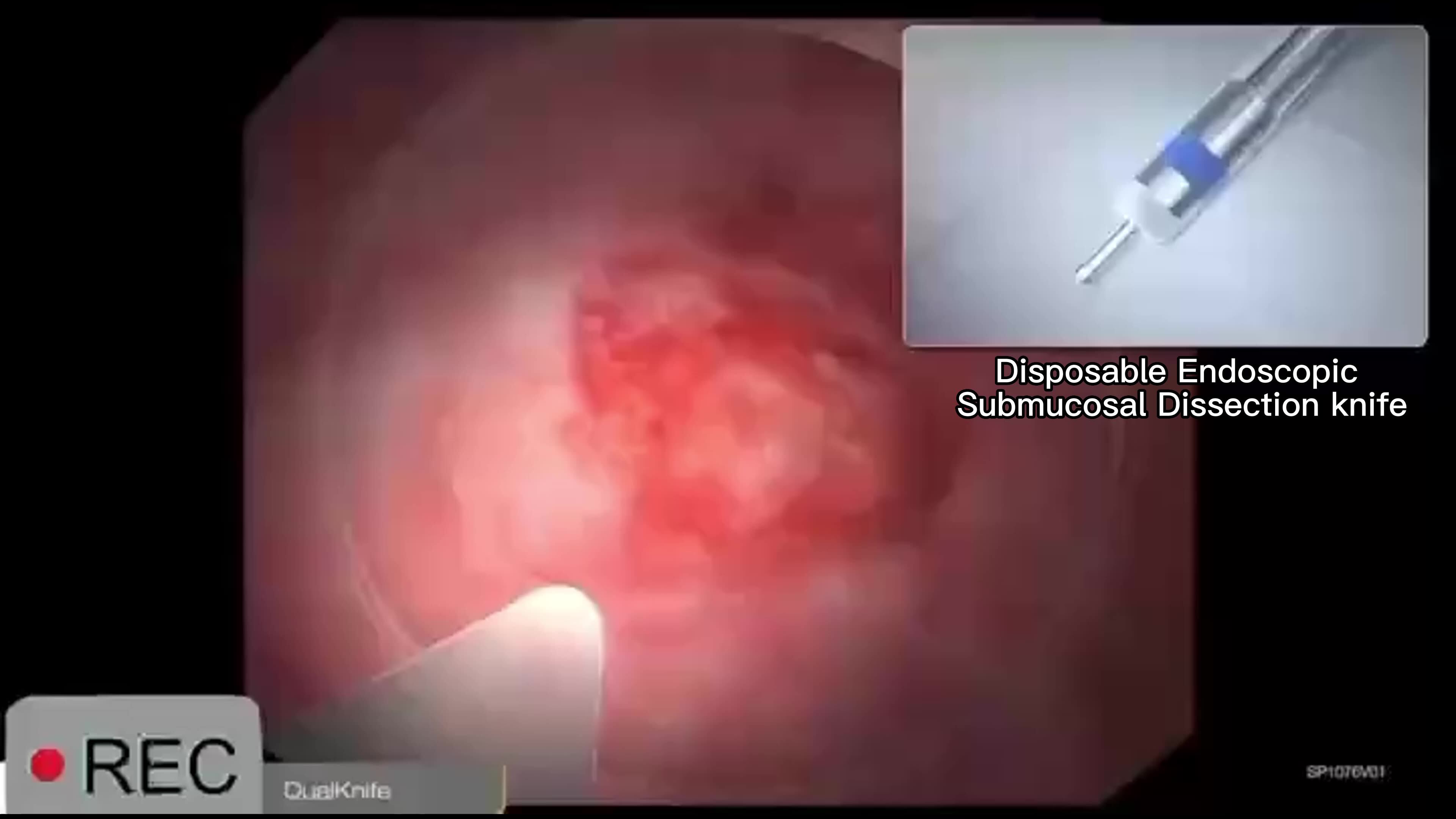 Disposable Rotatable Loopnet Disposable Endoscopic Flexible Rotatable Hemoclip Endoscopy For ...