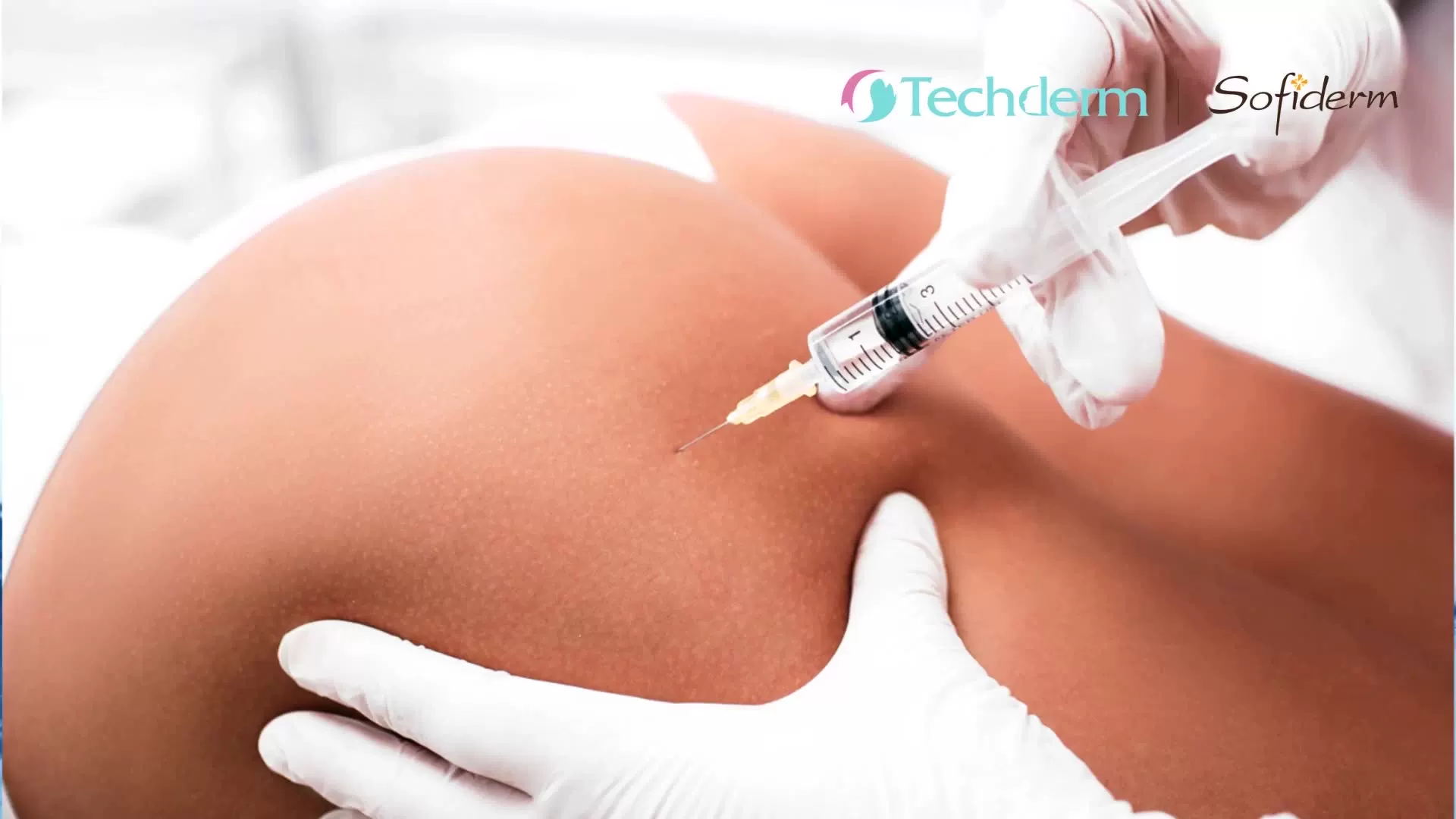 Инъекционный липолиз. Мезотерапия ягодиц. Мезотерапия тела липолитиками. Мезотерапия ягодиц. Озонотерапия.