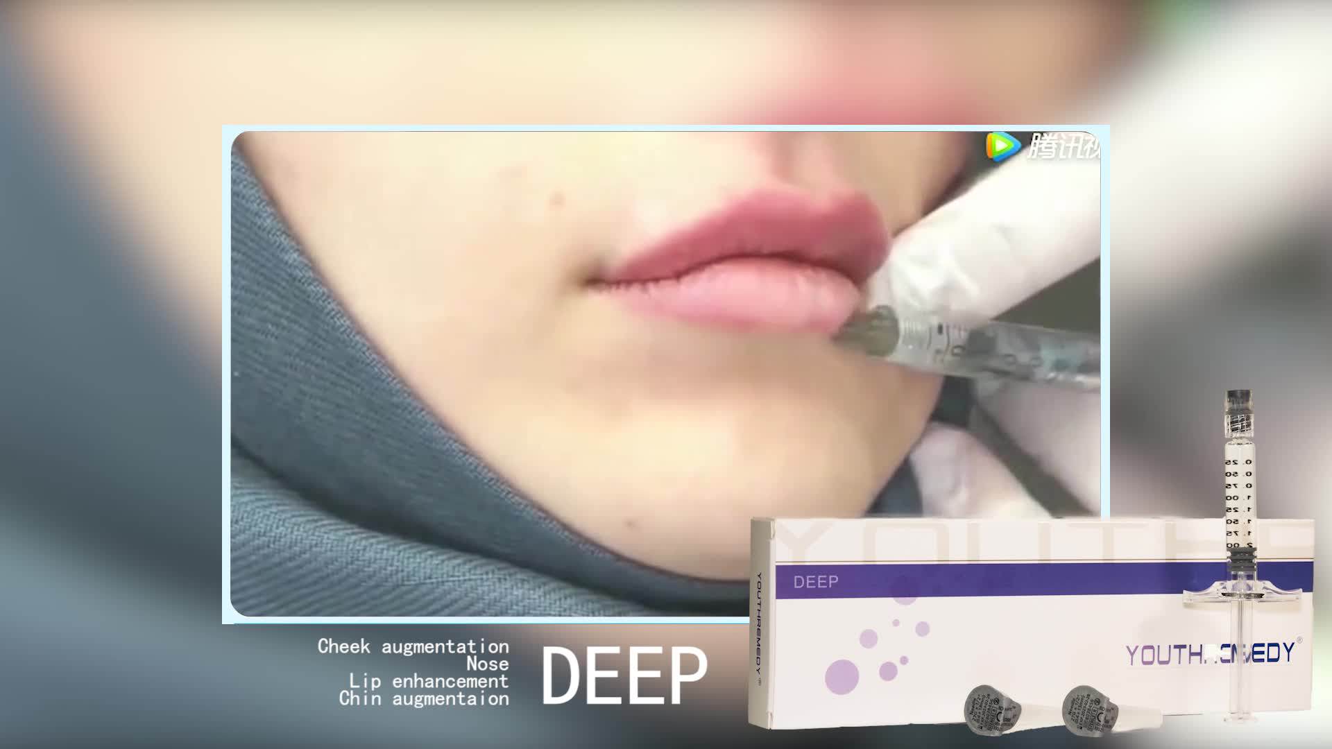 Korea Oem Deep Wrinkle Facial Filler Hyaluronic Acid Dermal 2ml Buy