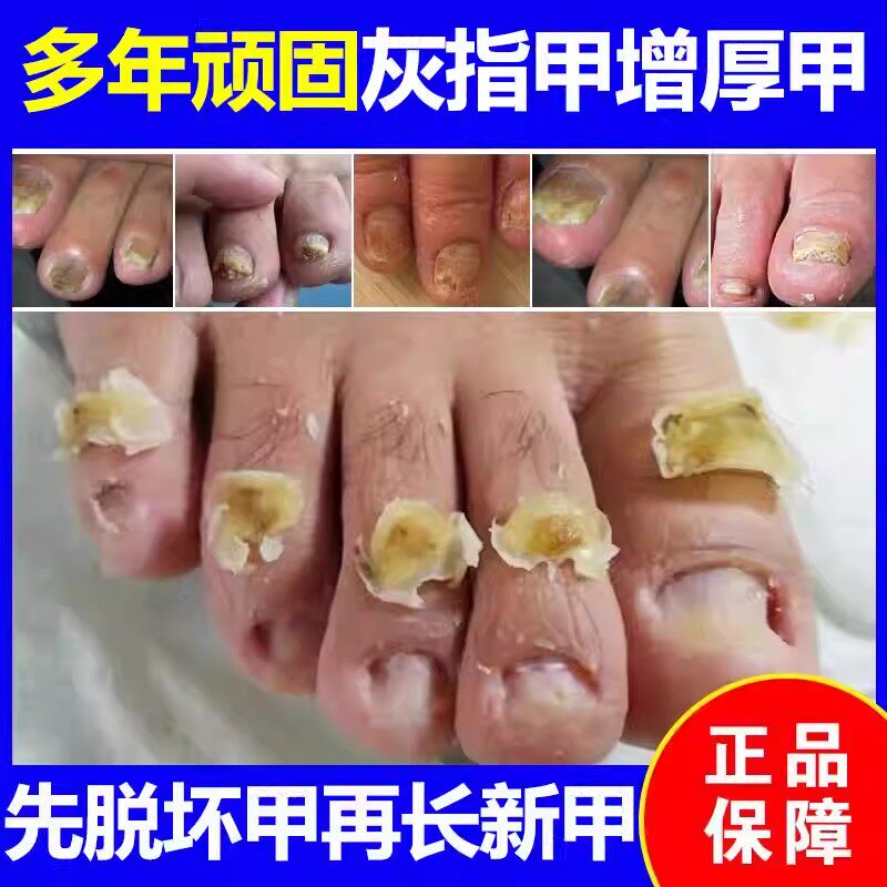 Herbal Nail Removal Cream Specialized Nail Removal Liquid for Paronychia and Grey Toenails, Rapid Nail Removal, Nail Softener Essential Oil