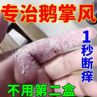 Hand ringworm ointment, foot, tinea fungus infection, peeling, dry cracking, blisters, eczema, Moss, itching, goose Palm wind medicine, psoriasis cream