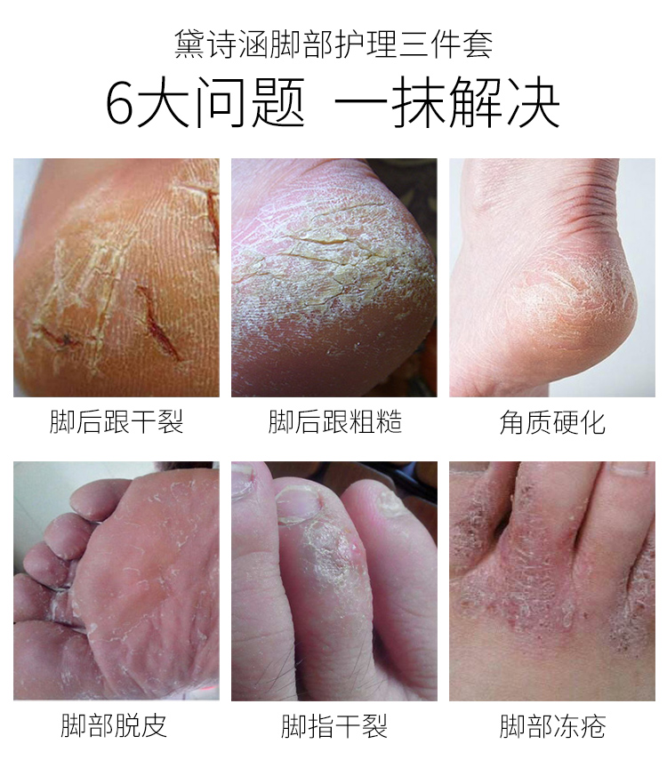 Chăm sóc chân ba mảnh phù hợp với đôi chân trắng dịu dàng tẩy tế bào chết da cũ Kem bôi chân kem tẩy tế bào chết mặt nạ ủ chân lột da chết