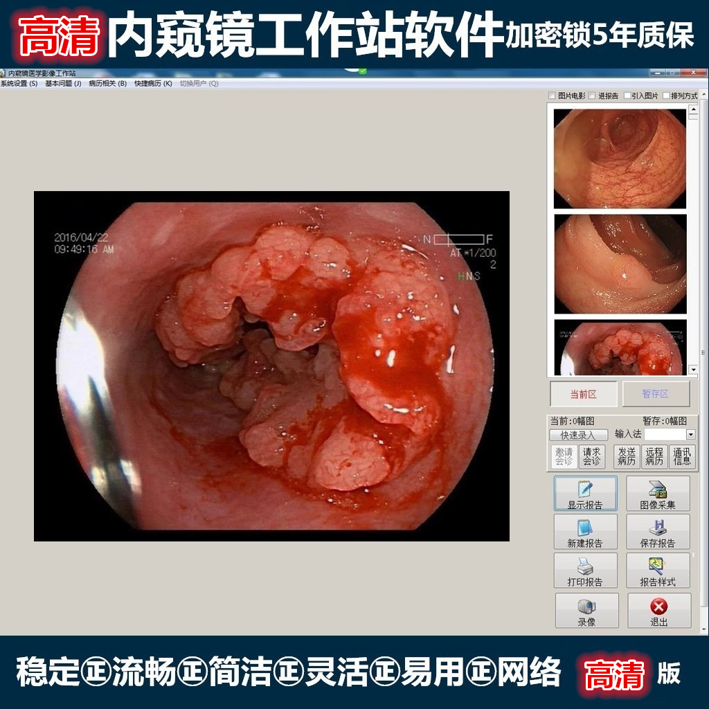 内镜工作站软件胃肠镜图文采集系统卡网络版正版加密锁狗版包邮