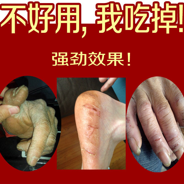 Cracked feet, cracked hands, cracked feet, cracked feet, cracked feet, cracked heels, cracked heels, cracked feet, cracked skin, cracked feet, cracked feet, cracked feet, cracked feet, cracked feet, cracked feet, cracked feet, cracked feet, cracked feet, cracked feet, cracked feet