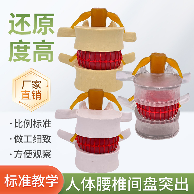 人体腰椎间盘受压演示模型腰椎放大模型病态脊柱脊椎骨骼关节模型