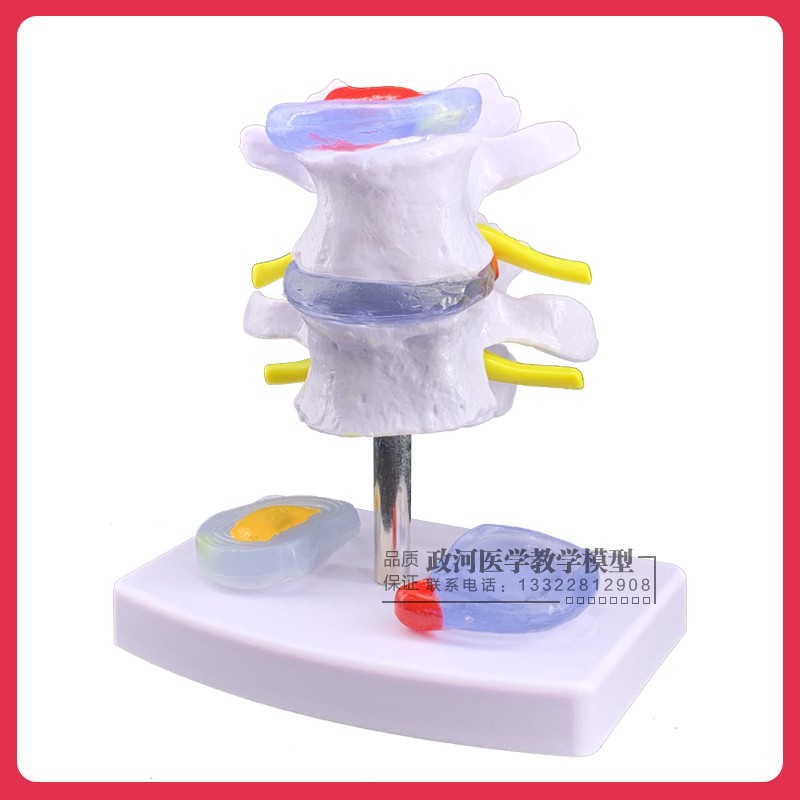 Disc herniated model skeletal pathology model lumbar skeletal medical teaching with model medical teaching
