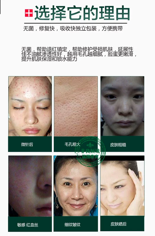 Làm đẹp y tế vô trùng yếu tố EGF giải pháp chứng khoán oligopeptide dưỡng ẩm mặt sửa chữa nhạy cảm 祛 làm mờ vết mụn serum vàng