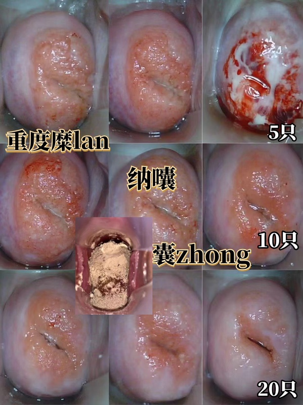 Gongfen Neck Powder, Fire-Reducing Enzyme, Bacteria, Parasites, White Discharge Eliminating Powder