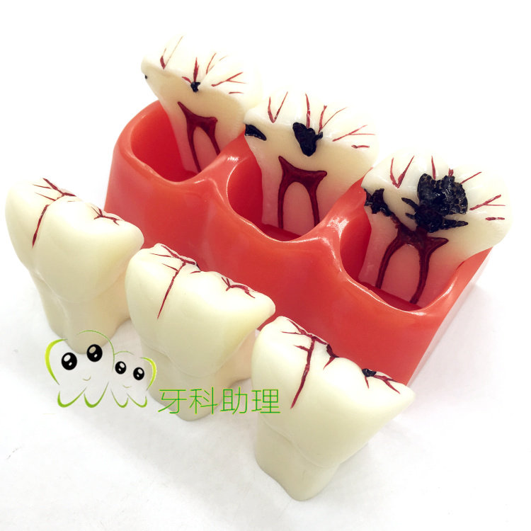 Dental Oral Model 4 times Caries Decomposition Model Caries of Caries Show Caries Development Natural tooth morphology