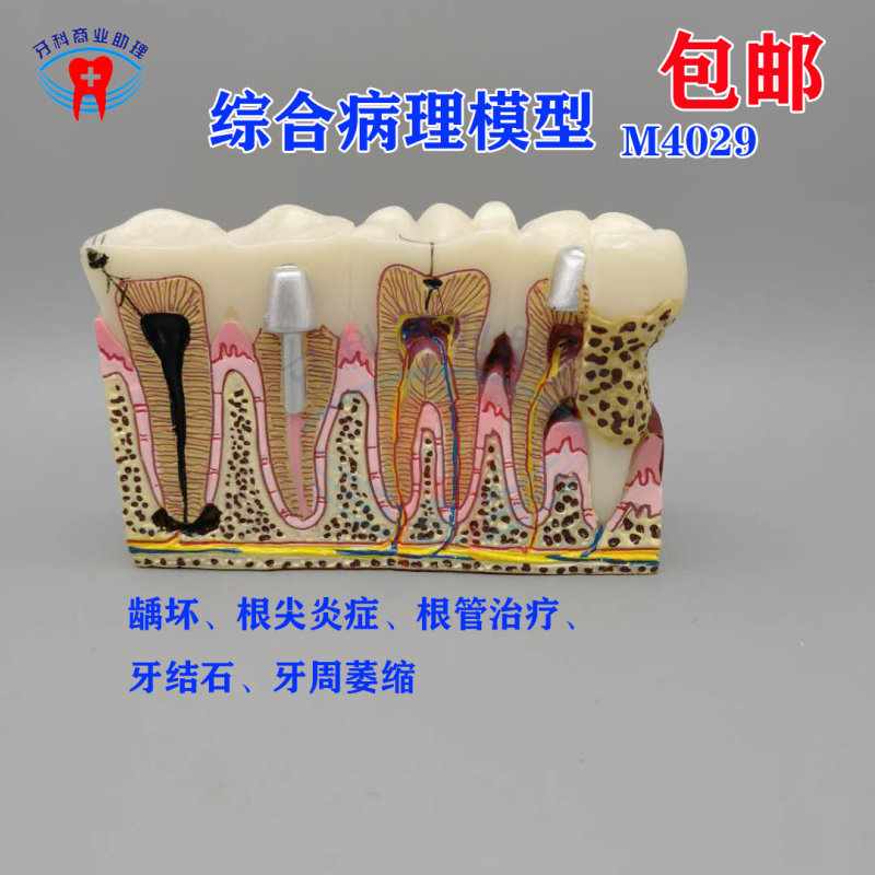 牙科6倍综合病理模型 龋坏根尖根管牙结石牙龈萎缩 牙周M4029包邮