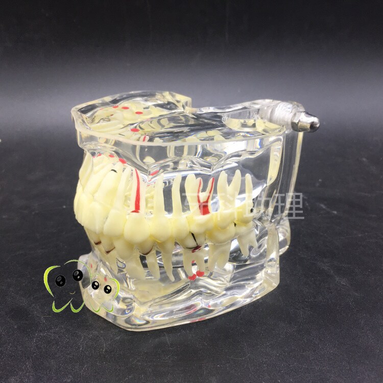 Dental Oral Teaching Model Adult Pathology Crystal Model Cultivation Dental Caries Wisdom Tooth Missing Demonstration Cases-Taobao