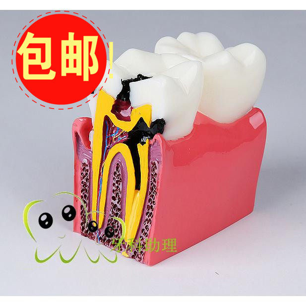 Dental Oral Teaching Teeth Model 6 Times Carious Teeth Contrasting doctor-patient communication tooth structure Anatomy 