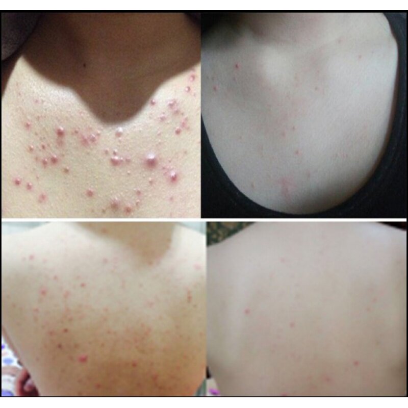 Ointment for root bark cystitis folliculitis to cure facial pimple Acne Seminal Scalp Back Thoracic Vulva
