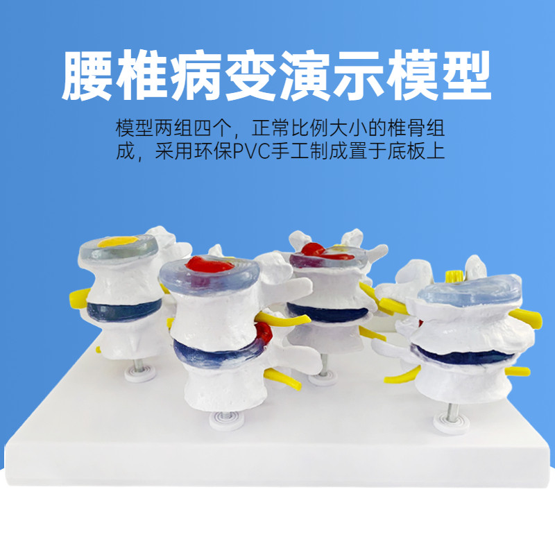 四阶段病变腰椎模型骨骼病理模型椎间盘突出骨骼变形脊柱脊椎教具