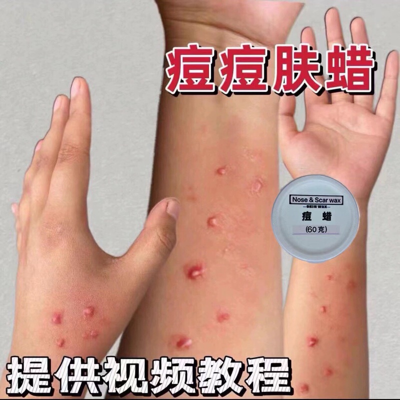 Fake Acne Makeup for Film and Television, Ugly Woman Costume, Special Effects Makeup, Skin Wax, Simulated Acne Wax, Allergic Acne Simulation, Prank